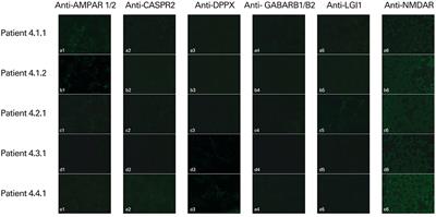 Occult Autoimmune Background for Epilepsy—The Preliminary Study on Antibodies Against Neuronal Surface Antigens